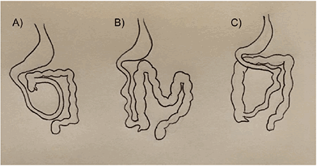 Figure 5: Types of malrotation: (A) depicts incomplete rotation, (B) depicts reverse rotation, (C) depicts nonrotation.