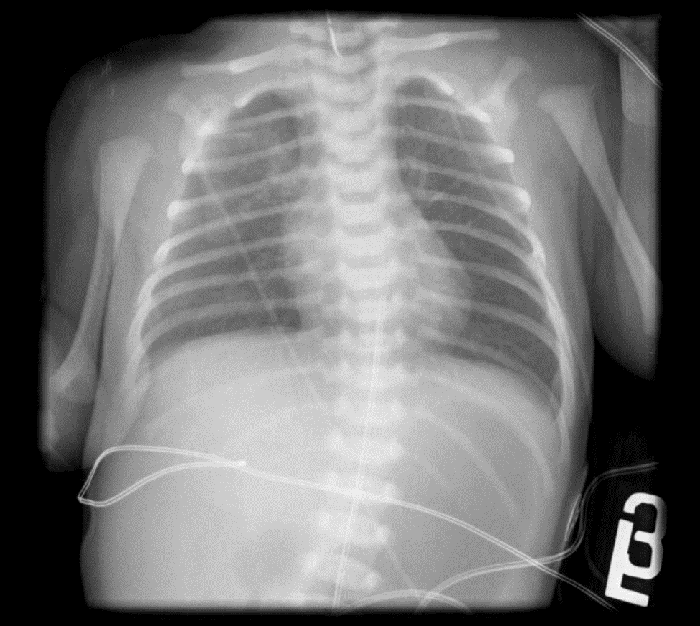 Figure 1. Chest radiograph demonstrates a distended gas-filled stomach, and a Replogle tube in the esophagus which met resistance at the proximal esophageal pouch at the level of the clavicle.