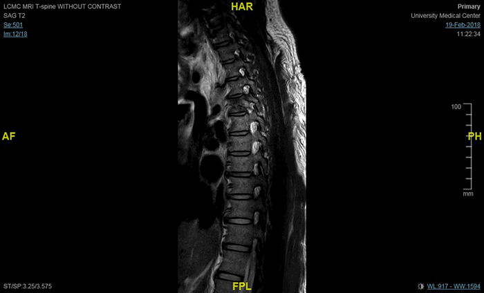 Figure 6. MRI thoracic spine without contrast, T2: sagittal view