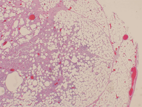 B) Subserositis