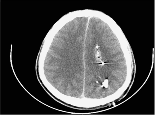 Bullet trajectory through the left posterior parietal area, terminating in the left parasagittal anterior frontal lobe. No contralateral injury