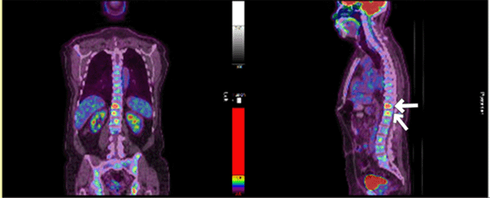 A (coronal and sagittal views): Heterogeneous and focal fluorodeoxyglucose (FDG) uptake within the spinal column, indicating bony disease involvement (white arrows)