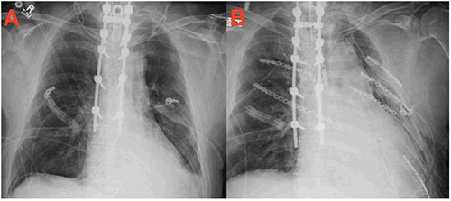 Figure 2: Figure 2A depicts an anterior-posterior preoperative chest x-ray and Figure 2B depicts an anterior-posterior postoperative chest x-ray following rib fixation.