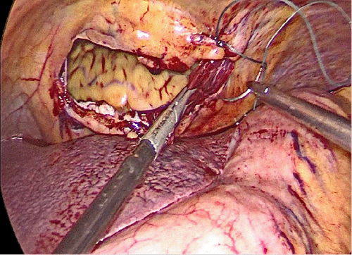 A) Defect Closure